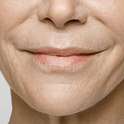 Perioral Wrinkles