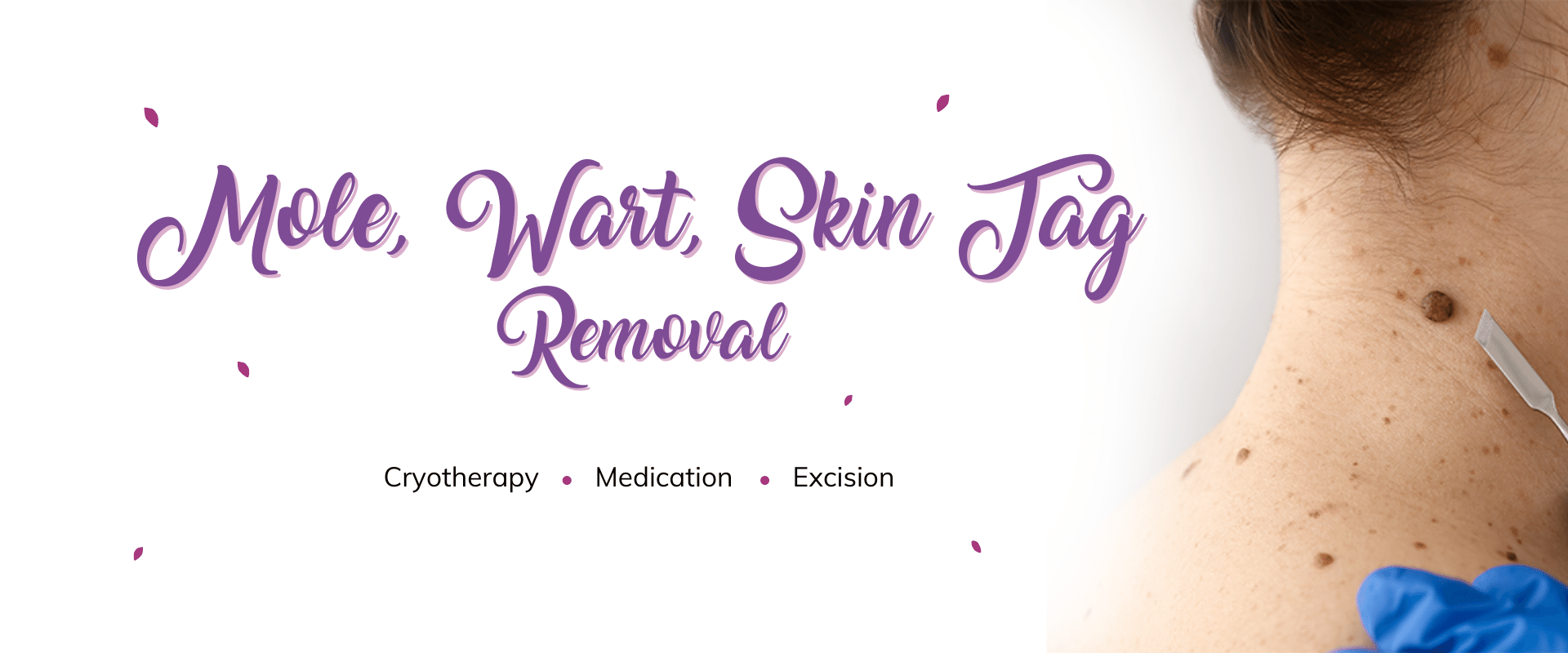 Mole, Wart Removal (R)