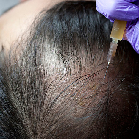 PRP Hair Treatment