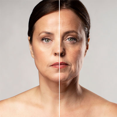 Face Lifting